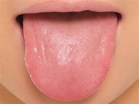 Large White Bump On Tongue