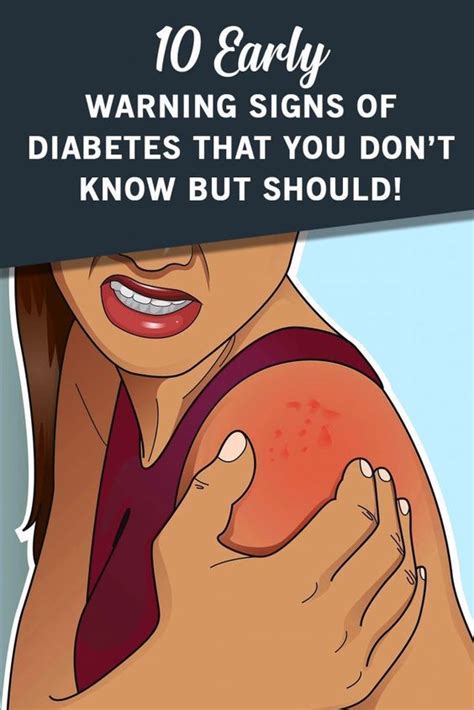 Early Warning Signs Of Diabetes That We Should Not Ignore Wellness Webs