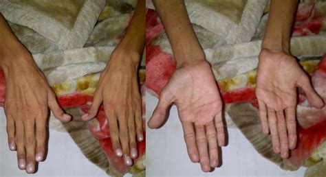 Marfan Syndrome Hands