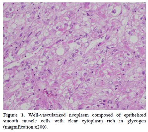 Asymptomatic Pancreatic Perivascular Epithelial Cell Tumor Pecom