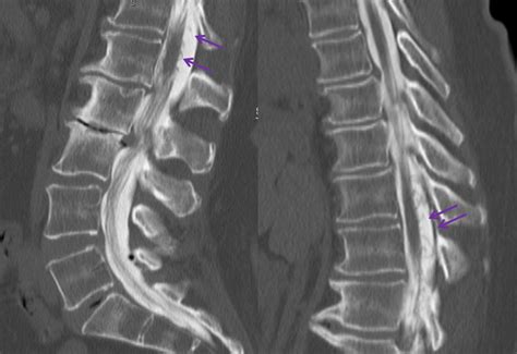 Lumbar Spine Ct Myelogram Lumbar Spine