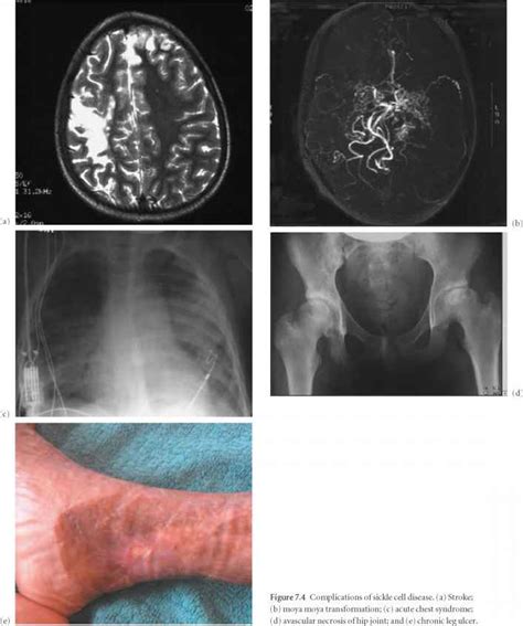 How many forms of combating malaria are there? Pulmonary complications - Haemolytic Anaemia - European ...