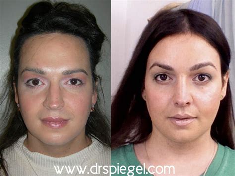 9 Sex Reassignment Surgery A Transgender Woman Who Is Also Transgender Surgeries Male To