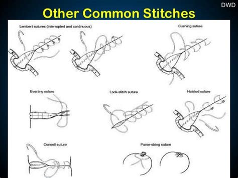 Surgical Sutures And Suturing Techniques Surgical Suture Sutures