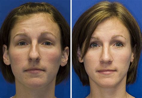 Bulbous Nasal Tip Case Study Seattle Facial Plastic Surgeon Dr