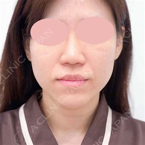 Aclinicの1day小顔脂肪吸引はとても満足度の高い施術です♡しっかり小顔に♬3週間後の症例写真です 30代女性 A Clinicは小顔・リフトアップ専門の美容整形クリニック