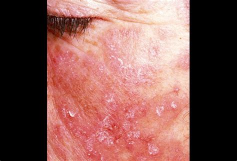 Picture Of Systemic Lupus Erythematosus Picture Image On