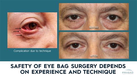Discover More Than Removing Eye Bags Without Surgery Super Hot Esthdonghoadian