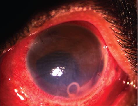 Live Juvenile Strobilate Tapeworm In The Anterior Chamber Of The Human