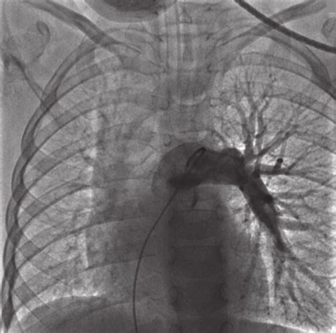 Cateterismo Cardiaco Agenesia De La Arteria Pulmonar Derecha