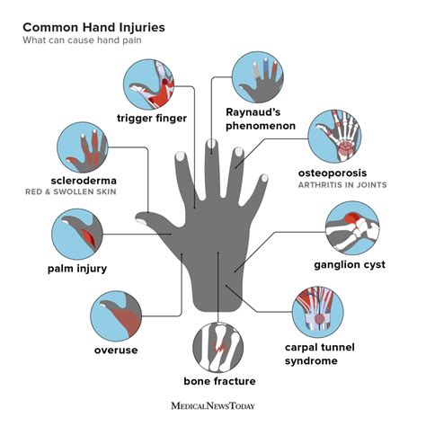 Hand Pain Causes Home Remedies And Treatments