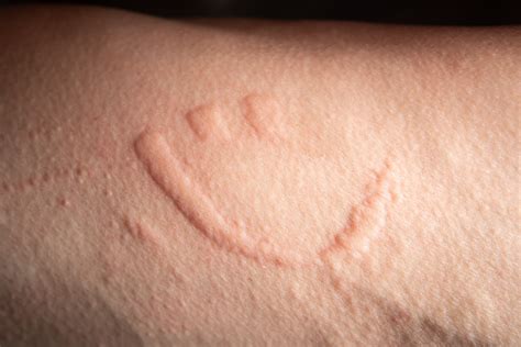 Dermatographia Causes Risk Factors And 7 Potential Treatments Suzy Cohen Rph Offers Natural