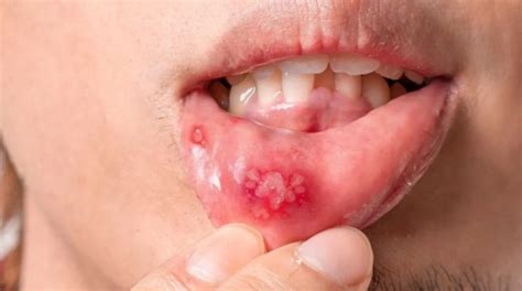 Mouth Sore What Is It Causes Symptoms And Treatment At A Glance