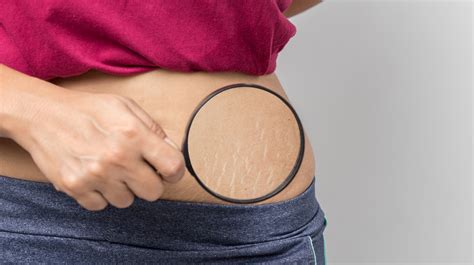Home Remedies That Can Reduce The Appearance Of Stretch Marks