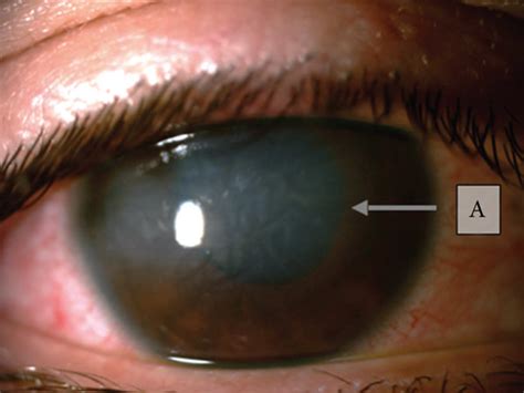Corneal Edema In The Right Eye During Tass As Seeing Both With Diffuse Download Scientific
