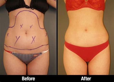 Beverly Hills Liposuction Female Patient Before After Picture Shows