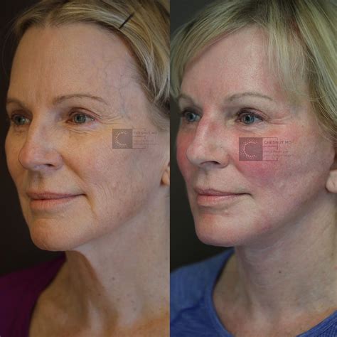 Patient 36217238 Laser Resurfacing Before And After Clinic 5c
