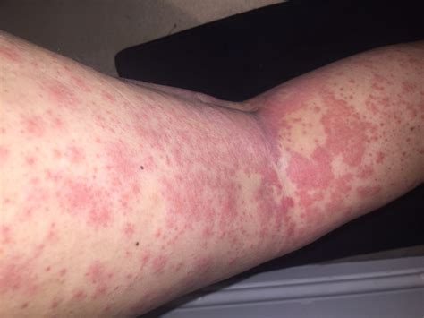 Serious Conditions That Rashes And Hives Can Indicate Page Things Health