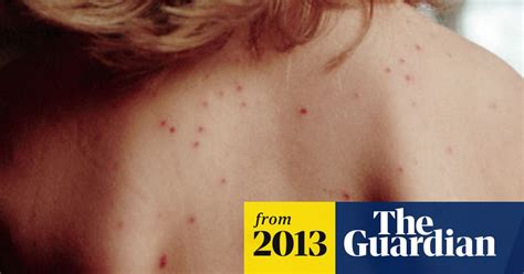 Measles What You Need To Know About The Disease Health The Guardian