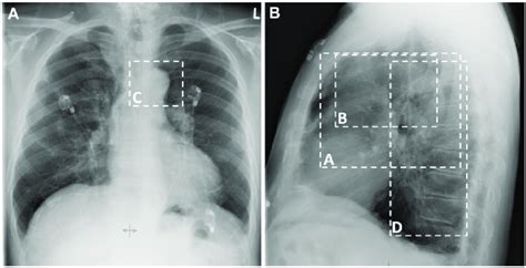 Aortic Calcification Chest X Ray