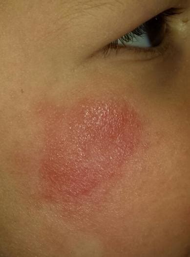 Red Mark On Face