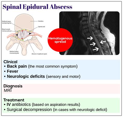 Pdf Spinal And Intracranial Epidural Abscess Hot Sex Picture