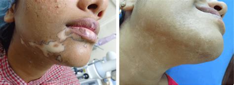 Leucoderma Vitiligo Causas Síntomas Y Tratamiento Kathryn Coltrin