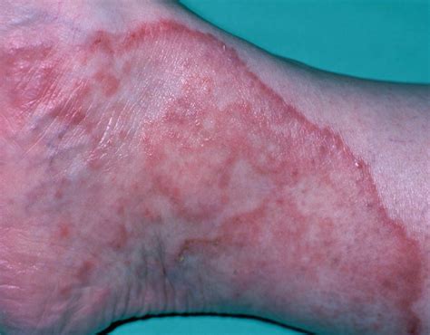 Ringworm Or Athlete S Foot A Dermatophyte Infection Caused By A Fungus