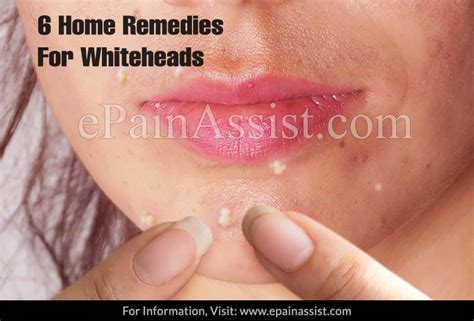 6 Home Remedies For Whiteheads