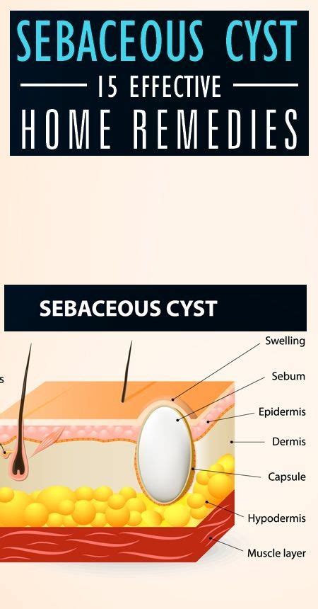 15 Best And Effective Home Remedies To Treat Sebaceous Cyst Health