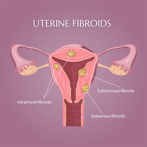 Uterine Fibroids Signs And Symptoms Treating Uterine Fibroids