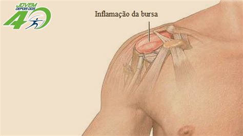 BURSITE NO OMBRO CAUSAS SINTOMAS E TRATAMENTO YouTube