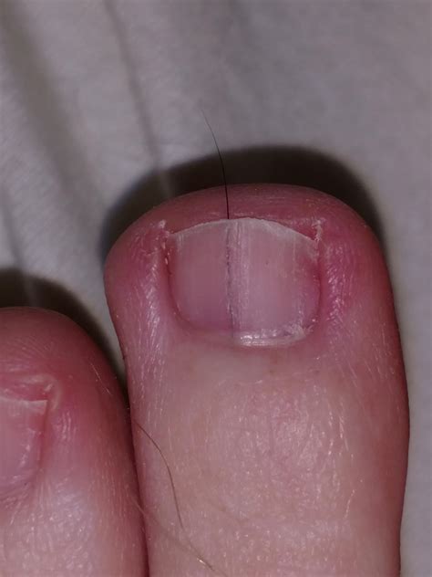 Hair Growing Under My Toe Nail What Do Rwtf
