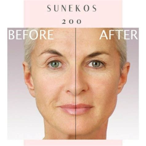 Sunekos Treatment Lincoln Laser Skincare Lincoln Laser Skin Care