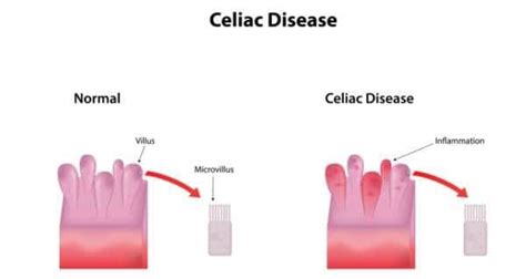 Celiac Disease Health Tips Celiac Disease Health Articles Health