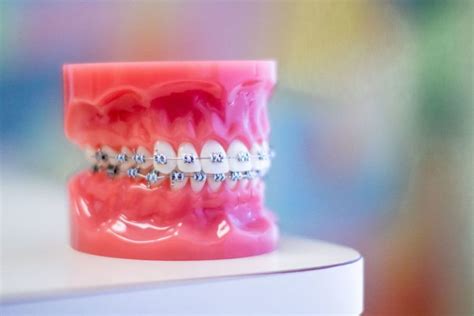 10 Myths About Braces You Need To Know Orthodontic Specialists