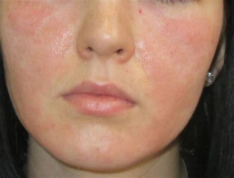 Аллергия на лице лечение виды аллергических высыпаний симптомы