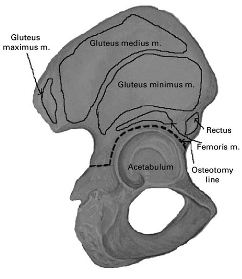 Diagram Of The Pelvis Showing The Line Of The Dome Osteotomy For