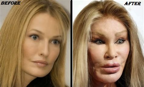 Jocelyn Wildenstein Transformation Before And After Surgery Plastic