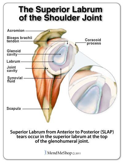 Here's how it differs from the others, what the treatments are, and when you might need surgery. The superior labrum may tear (superior labrum from anterior to posterior tears) at the top of ...
