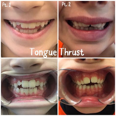 how to stop tongue thrusting teeth recognizing tongue thrust patients registered dental