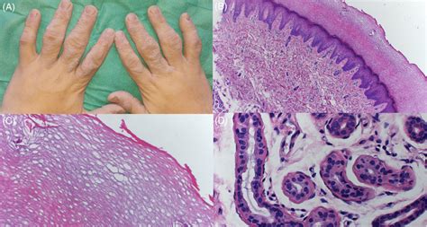 A Hyperkeratosis And Redundant Skin In Interphalangical Joints