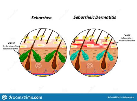 Causes Seborrhea Skin And Hair Dandruff Seborrheic Dermatitis Eczema Ilustración Del Vector