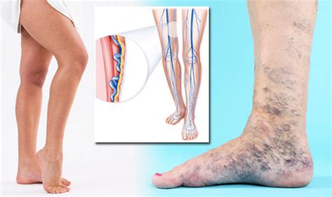Varicose Veins What Is The Treatment For Condition That Causes Pain