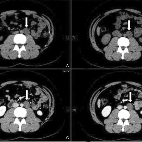 A And B Plain Scans C And D Contrast Enhanced Ct Scans A And C