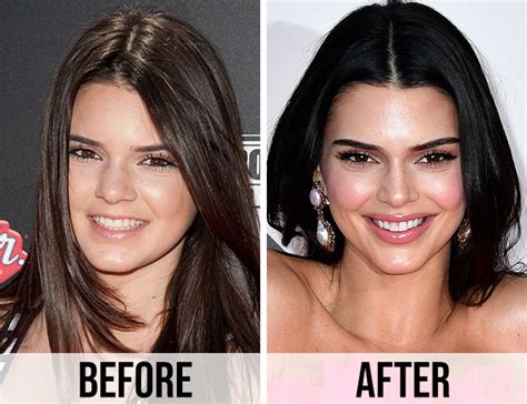 These Before And After Pics Of Kendall Jenner Are Insanewhat Did She