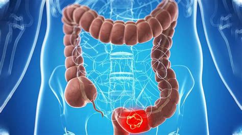 Whether it is present only in the. What You Need to Know About The Stages of Colon Cancer ...