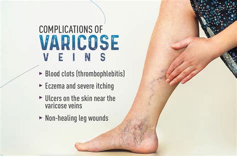 Complications Of Varicose Veins