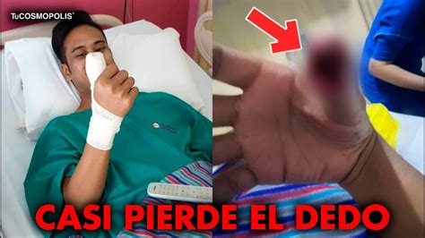 Joven Casi Pierde El Pulgar Tras Usar Su Celular Con La Pantalla Rota