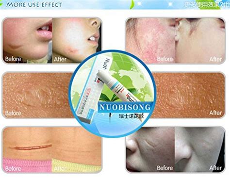Nuobisong Face Care Acne Scar Removal Cream Whitening Face Cream